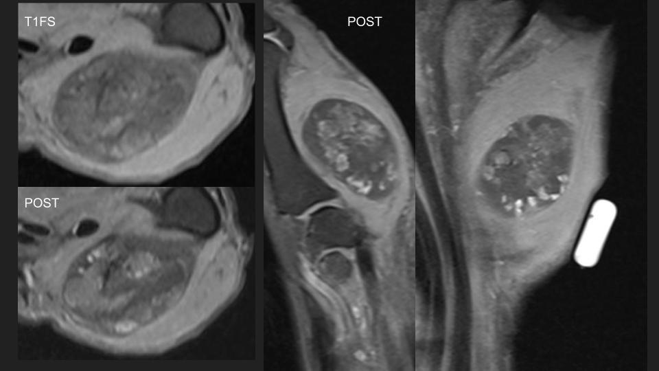 Figure 4 for case chondroma ( RID4126 )
